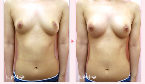 ヒアルロン酸豊胸 症例写真1
