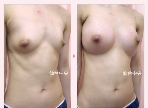 既婚の豊胸手術 症例写真2