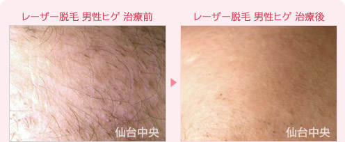レーザー脱毛 男性ヒゲ