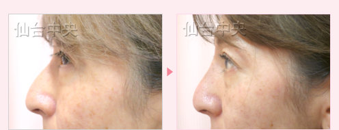 鷲鼻削りと鼻プロテーゼ 症例写真10