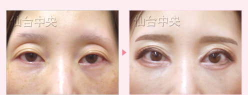 眼瞼下垂 症例写真4